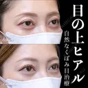 目の上ヒアルロン酸 30日後 サムネイル用