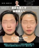 バッカル・メーラー・ジョールファット除去と糸リフト before画像 サムネイル用