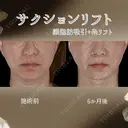 サクションリフト before画像 サムネイル用