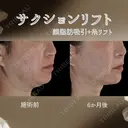 サクションリフト 180日後 サムネイル用