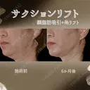 サクションリフト 180日後 サムネイル用