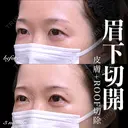 眉下切開/ROOF切除 90日後 サムネイル用