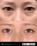Dr浦野執刀🌿切らない目の下のクマ取り after画像 サムネイル用