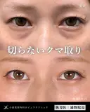 Dr浦野執刀🌿切らない目の下のクマ取り before画像 サムネイル用