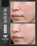 ルメッカ 30日後 サムネイル用
