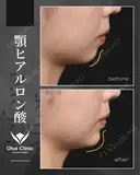 ヒアルロン酸注入（顎） 14日後 サムネイル用