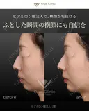 ヒアルロン酸注入（顎） before画像 サムネイル用