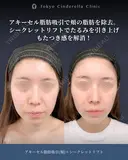 アキーセル脂肪吸引(頬)/シークレットリフト8本 before画像 サムネイル用
