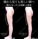 太もも全面　膝全周　脂肪吸引 before画像 サムネイル用
