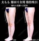 太もも全面　膝全周　脂肪吸引 180日後 サムネイル用