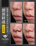 人中短縮 （鼻柱切開）・鼻翼縮小・鼻翼挙上・貴族組織移植 90日後 サムネイル用