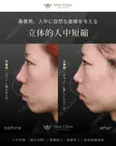 人中短縮 （鼻柱切開）・鼻翼縮小・鼻翼挙上・貴族組織移植 before画像 サムネイル用