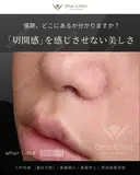 人中短縮 （鼻柱切開）・鼻翼縮小・鼻翼挙上・貴族組織移植 90日後 サムネイル用