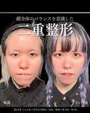 たるみ取り併用全切開二重術/眼瞼下垂手術/MD式 90日後 サムネイル用