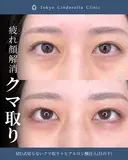 切らないクマ取り/ヒアルロン酸注入(目の下)/MD式 7日後 サムネイル用