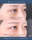 切らないクマ取り/ヒアルロン酸注入(目の下)/MD式 before画像 サムネイル用