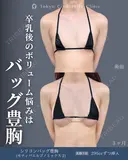 シリコンバッグ豊胸(モティバエルゴノミックス2) 90日後 サムネイル用