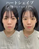 ハートシェイプほほ骨下ヒアルロン酸（ボリューマ）2cc after画像 サムネイル用