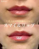 スマイルリップ（ボルベラ） before画像 サムネイル用