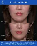 ジュブゼン（ほうれい線） before画像 サムネイル用