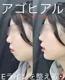 アゴ(ボラックス2㏄) after画像 サムネイル用