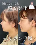 ペリカン手術 before画像 サムネイル用