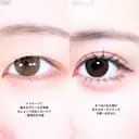 アリエルクイックループトリプル二重埋没法 before画像 サムネイル用