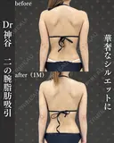 二の腕脂肪吸引（二の腕全周、肩、ブラファット） before画像 サムネイル用