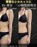 二の腕脂肪吸引（二の腕全周、肩、ブラファット） after画像 サムネイル用