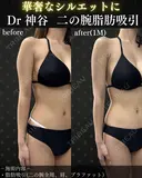 二の腕脂肪吸引（二の腕全周、肩、ブラファット） after画像 サムネイル用