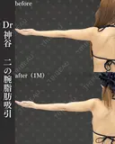 二の腕脂肪吸引（二の腕全周、肩、ブラファット） after画像 サムネイル用