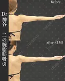 二の腕脂肪吸引（二の腕全周、肩、ブラファット） after画像 サムネイル用