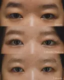 二重埋没 before画像 サムネイル用