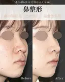 鼻中隔延長(肋軟骨)・猫手術・貴族手術 after画像 サムネイル用