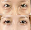 裏ハムラ法 before画像 サムネイル用