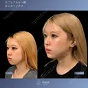 Eライン形成💖《あごヒアルロン酸×あごボトックス》 after画像 サムネイル用