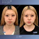 Eライン形成💖《あごヒアルロン酸×あごボトックス》 after画像 サムネイル用
