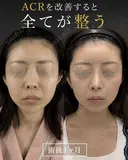 鼻フルカスタム before画像 サムネイル用