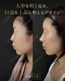 鼻フルカスタム before画像 サムネイル用