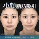 脂肪吸引（顔全体）＋バッカルファット除去 before画像 サムネイル用