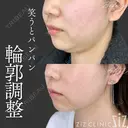 【輪郭調整】笑うとパンパン after画像 サムネイル用