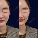 ヒアルロン酸注入（立ち耳） after画像 サムネイル用
