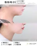 脂肪吸引（エラ下・あご下・フェイスライン） before画像 サムネイル用
