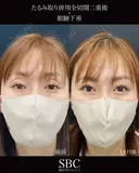 たるみ取り併用全切開二重術・眼瞼下垂 0日後 サムネイル用