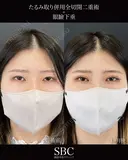 たるみ取り併用全切開二重術・眼瞼下垂 after画像 サムネイル用