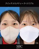 クイックコスメティーク・トリプル before画像 サムネイル用