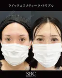 クイックコスメティーク・トリプル before画像 サムネイル用
