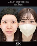 たるみ取り併用全切開二重術・ROOF切除 after画像 サムネイル用