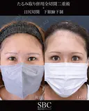 たるみ取り併用全切開二重術・目尻切開・下眼瞼下制 after画像 サムネイル用
