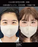 たるみ取り併用全切開二重術・目尻切開・下眼瞼下制・目頭切開 before画像 サムネイル用